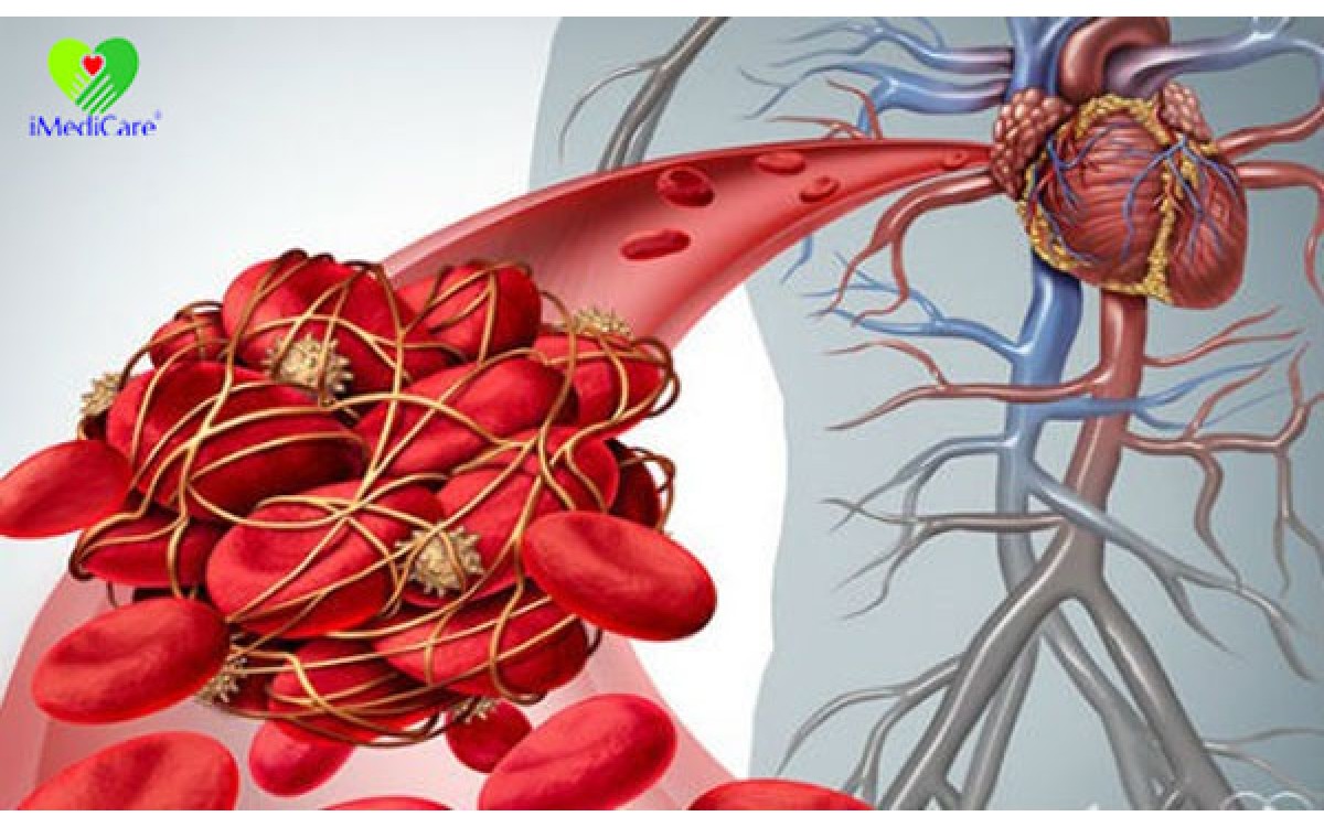 Dấu hiệu cảnh báo nguy cơ huyết khối gây tắc nghẽn mạch máu