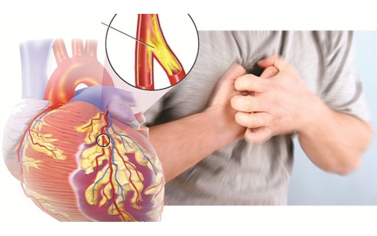 rối loạn nhịp tim - làm gì để có thể phòng bệnh rối loạn nhịp tim